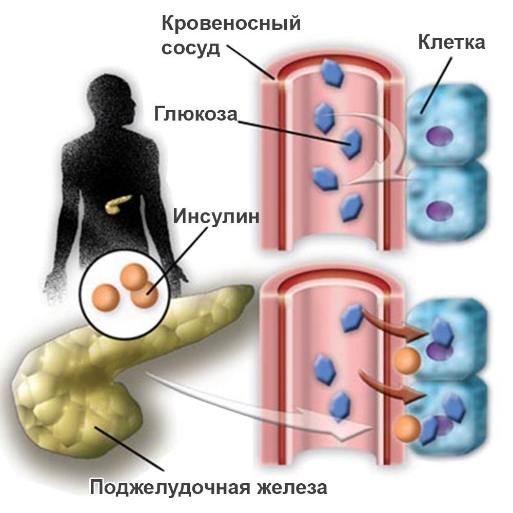 Курсовая Работа На Тему Сахарный Диабет У Детей 1 Типа