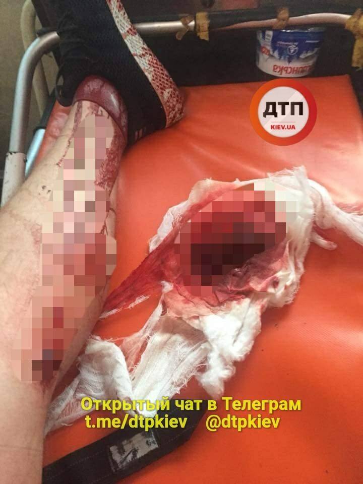 Ужасную травму ноги получил мужчина возле метро "Нивки" Ужасную травму ноги получил мужчина возле метро "Нивки"