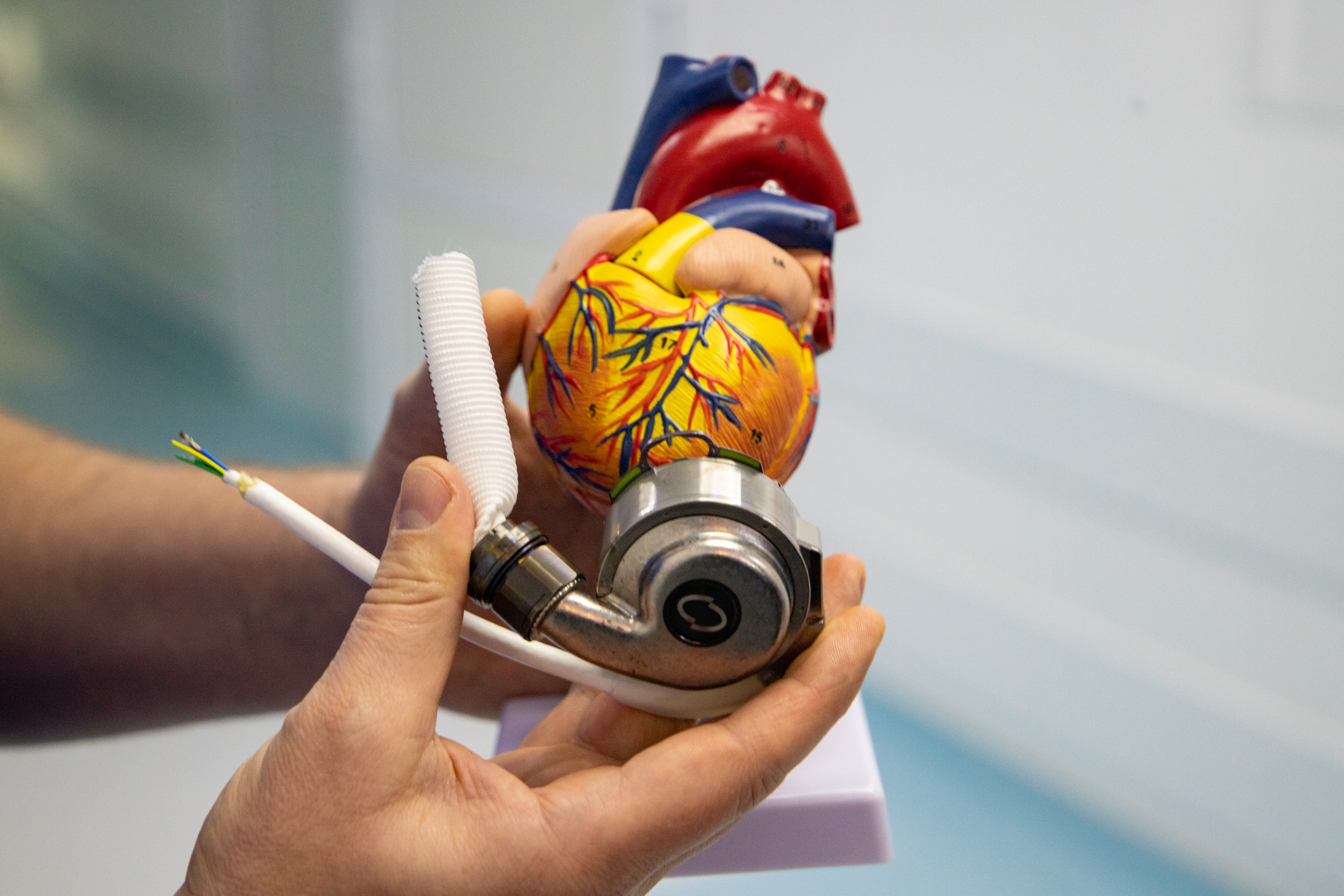 Столичные хирурги провели уникальную операцию по имплантации механического сердца