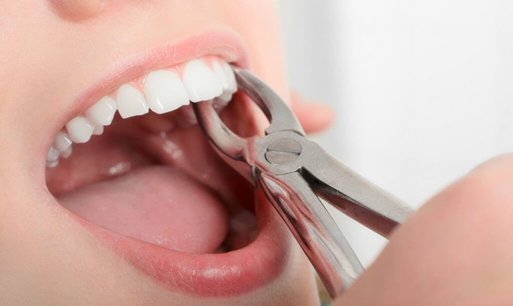 Удаление зуба мудрости – частая проблема современного человека